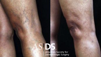 Spider vein removal Before & After
